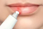El virus del herpes simple puede influir en cambios cerebrales asociados al alzhéimer Joven se aplica medicamento en pomada a un herpes labial