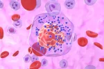 Compuesto podría eliminar la metástasis del cáncer de mama Ilustración de un tumor de mama triple negativo