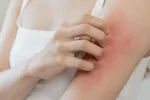 Rascarse aumenta la inflamación y retrasa la curación de lesiones Una joven se rasca el brazo inflamado y enrojecido