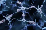 Confirman que la acumulación de beta amiloide puede predecir el alzhéimer Placas amiloides en la enfermedad de Alzheimer