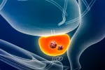 Españoles crean nanopartículas que liberan fármacos en tumores de próstata Ilustración de células cancerosas en un tumor de próstata