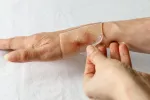 Desarrollan un adhesivo inspirado en mejillones y moco humano con propiedades antibacterianas Apósito transparente autoadhesivo sobre una cicatriz en el brazo de una mujer