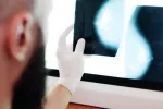 Un fármaco para tratar la osteoporosis potencia la respuesta inmune contra el cáncer de mama Médico observa imágenes de mamografía