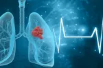 Pulmones con células cancerosas Ilustración de pulmones humanos con células tumorales