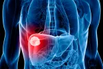 Inmunoterapia para tratar cáncer hepático avanzado Ilustración en 3D de un hepatocarcinoma irresecable