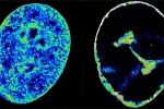 Células humanas antes y después de la infección por virus del herpes labial Células humanas antes y después de la infección por VHS-1