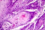 Carcinoma cutáneo de células escamosas, un tipo común de cáncer de piel Vista de carcinoma cutáneo de células escamosas a través del microscopio