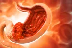 Cáncer de estómago o cáncer gástrico Ilustración de cáncer de estómago o cáncer gástrico