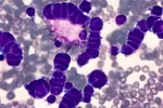 Cáncer de pulmón de células pequeñas, un tumor muy agresivo Imagen microscópica de la citología del fluido pleural de un carcinoma de célula pequeña