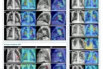 Mapas de activación generados mediante técnicas de explicabilidad que señalan las regiones de interés utilizadas por el modelo para tomar sus decisiones sobre las radiografías Radiografías de tórax