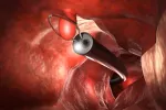 Tratamiento de lesiones rectales mediante endoscopia Endoscopio en 3D introducido rectalmente para intervernir