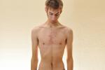 Anorexia y vigorexia afectan cada vez más a los hombres