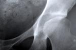 Radiografia de hueso con osteoporosis