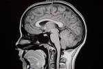 Diagnóstico de la neuralgia del trigémino