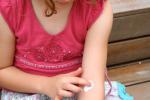 El eccema en la infancia eleva el riesgo de asma
