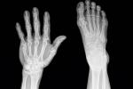 Radiografías de fractura de dedo