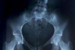 Radiografía de la próstata