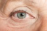Qué es el síndrome del ojo seco