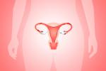 Relacionan la endometriosis con las dioxinas