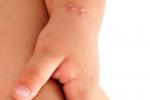 Síntomas del molusco contagioso en la piel