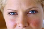 Síntomas de la rosácea en la cara de una mujer