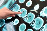 Radiografía del cerebro indicando un posible caso de de alzhéimer