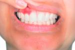 Asocian la psoriasis con más riesgo de periodontitis crónica