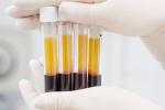 Biomarcador en el análisis de orina y sangre