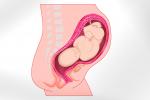 El cuello uterino ayuda a predecir un parto prematuro
