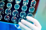 Radiografía del cerebro para un posible tratamiento del ictus