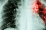 Radiografía de una fibrosis pulmonar idiopática 