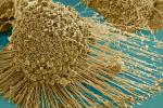 Logran frenar la metástasis del cáncer con nanopartículas de oro