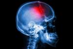 Radiografía del cerebro tras un ictus