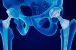 Radiografía de unos implantes metálicos en la cadera