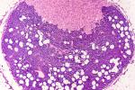 Imagen microscópica de la metástasis de los ganglios linfáticos