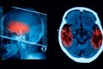 Tomografía de un cerebro con un ictus