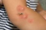 Picaduras de avispa en niña alérgica