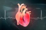 infarto de miocardio