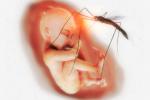 Asocian el zika con varias anomalías en el embarazo