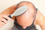 Hombre con problemas de alopecia
