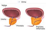 Gráfico de la hiperplasia benigna de próstata
