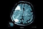 Qué son los tumores cerebrales