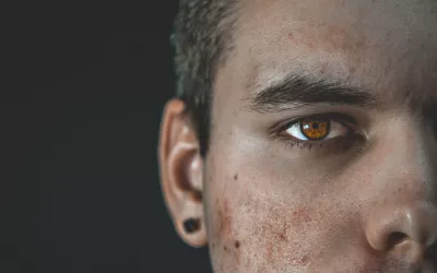 Marcas de acné y viruela en un hombre