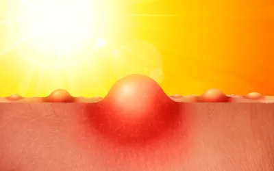 Medicamentos fotosensibles Medicamentos fotosensibles, contraindicados bajo el sol