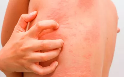 Urticaria acuagénica, la extraña alergia al agua Urticaria acuagénica, alergia al agua