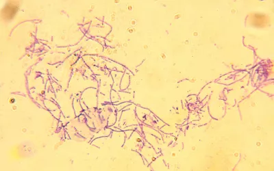 Carbunco o ántrax Bacillus anthracis