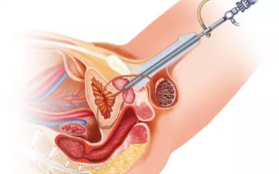 Cistoscopia Ilustración del procedimiento de una cistoscopia