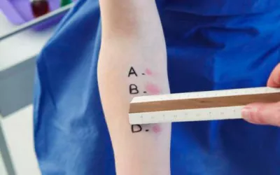 Mantoux Prueba de mantoux