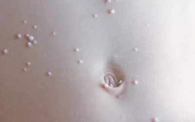 Qué es el molusco contagioso Niño con molusco contagioso