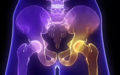Osteoporosis Osteoporosis vista en un radiografía